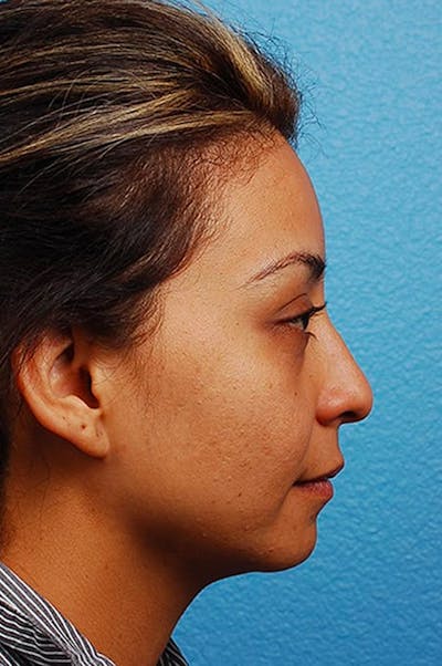 Rhinoplasty Before & After Gallery - Patient 318707 - Image 1