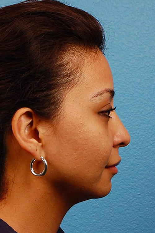 Hidden Patients Before & After Gallery - Patient 172416 - Image 2