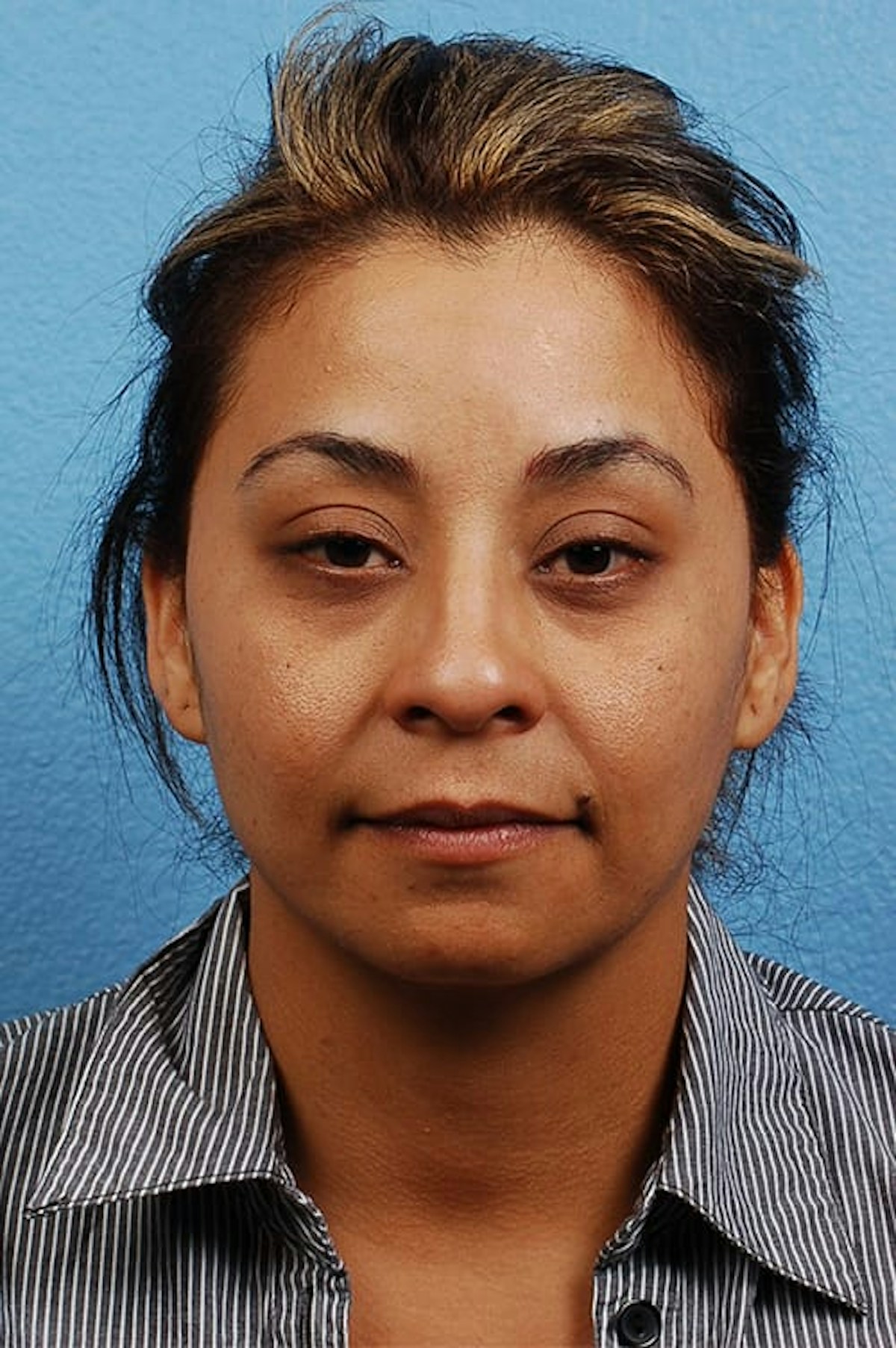Rhinoplasty Before & After Gallery - Patient 318707 - Image 3