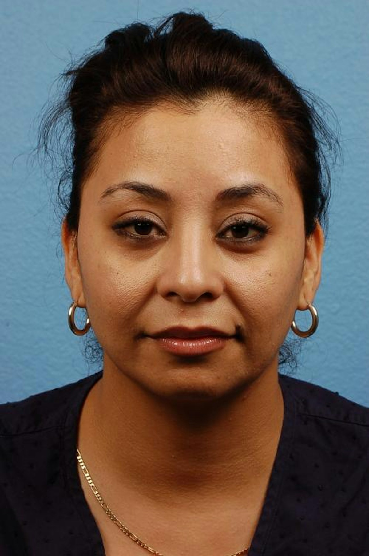 Rhinoplasty Before & After Gallery - Patient 318707 - Image 4