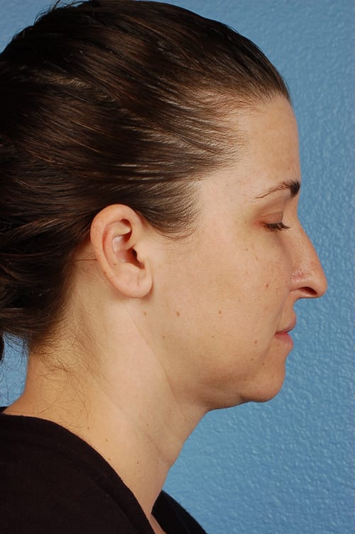 Rhinoplasty Before & After Gallery - Patient 378514 - Image 1