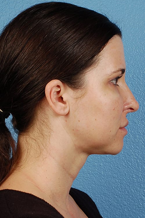 Rhinoplasty Before & After Gallery - Patient 378514 - Image 2