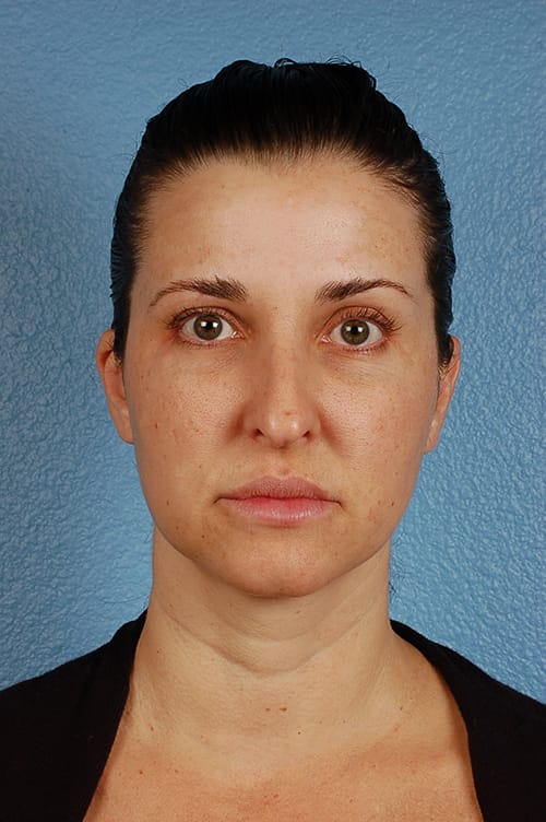 Rhinoplasty Before & After Gallery - Patient 378514 - Image 3