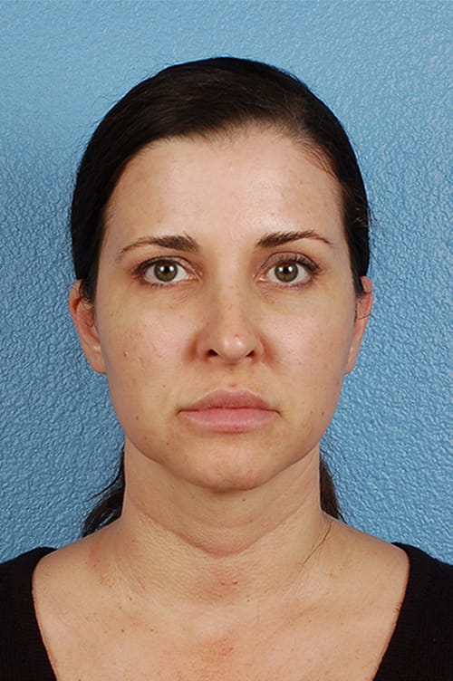 Rhinoplasty Before & After Gallery - Patient 378514 - Image 4
