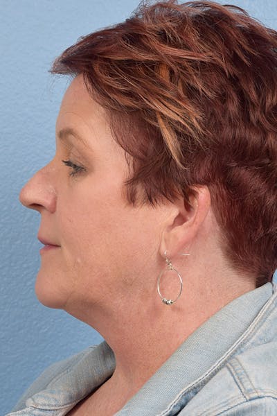 Rhinoplasty Before & After Gallery - Patient 346998 - Image 1