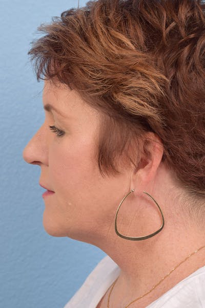 Rhinoplasty Before & After Gallery - Patient 346998 - Image 2