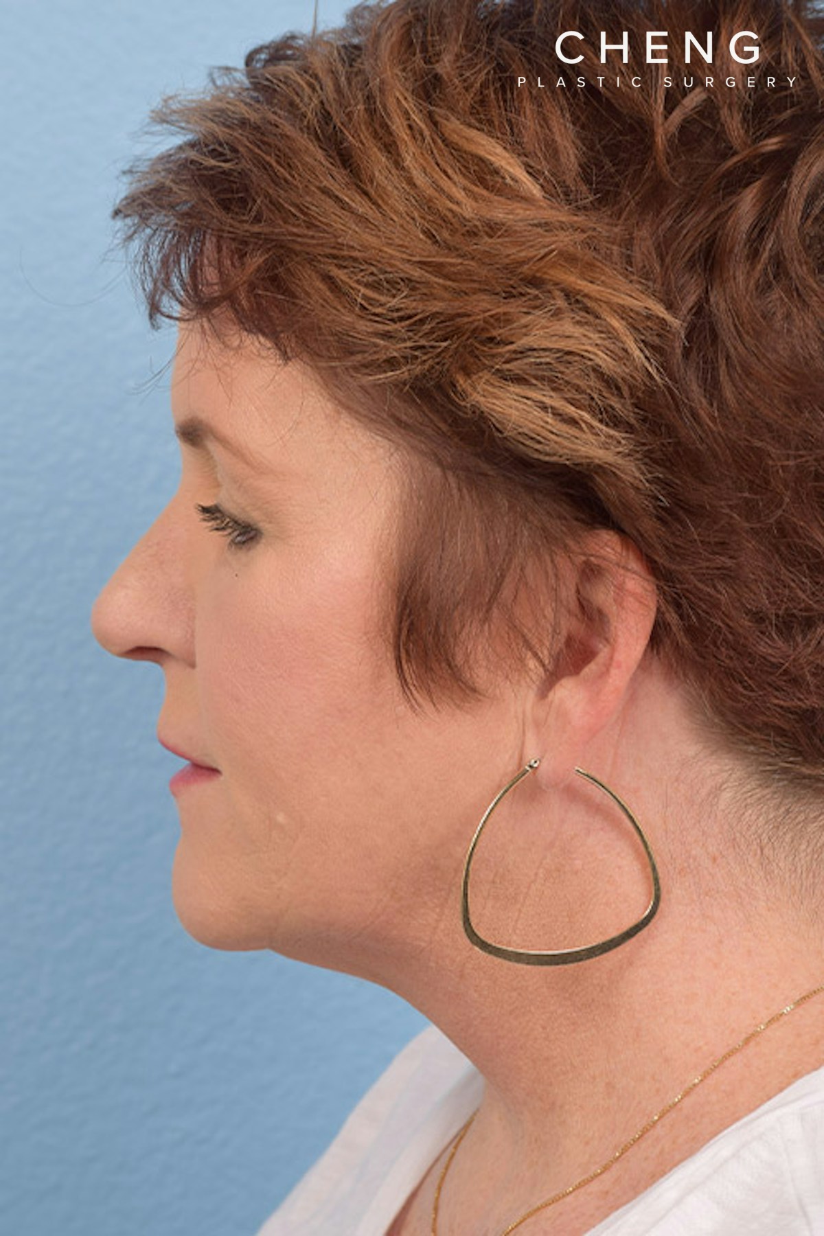 Hidden Patients Before & After Gallery - Patient 175118 - Image 2