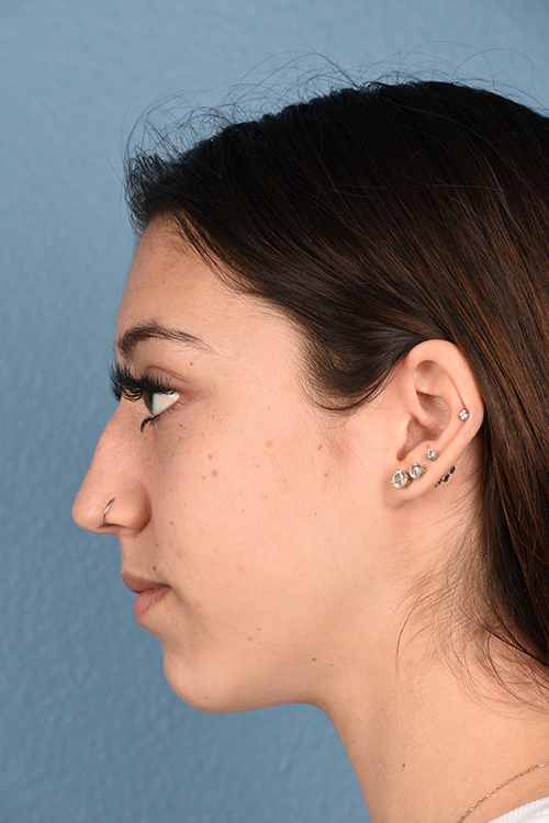 Chin Augmentation Before & After Gallery - Patient 290451 - Image 3