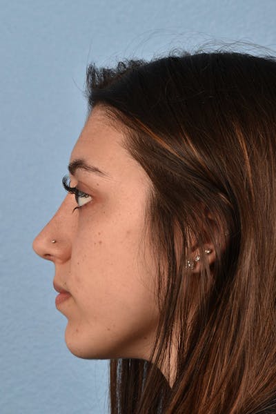 Rhinoplasty Before & After Gallery - Patient 304396 - Image 2