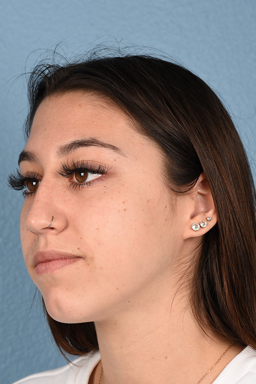 Chin Augmentation Before & After Gallery - Patient 290451 - Image 1