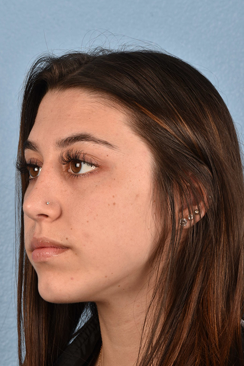 Chin Augmentation Before & After Gallery - Patient 290451 - Image 2