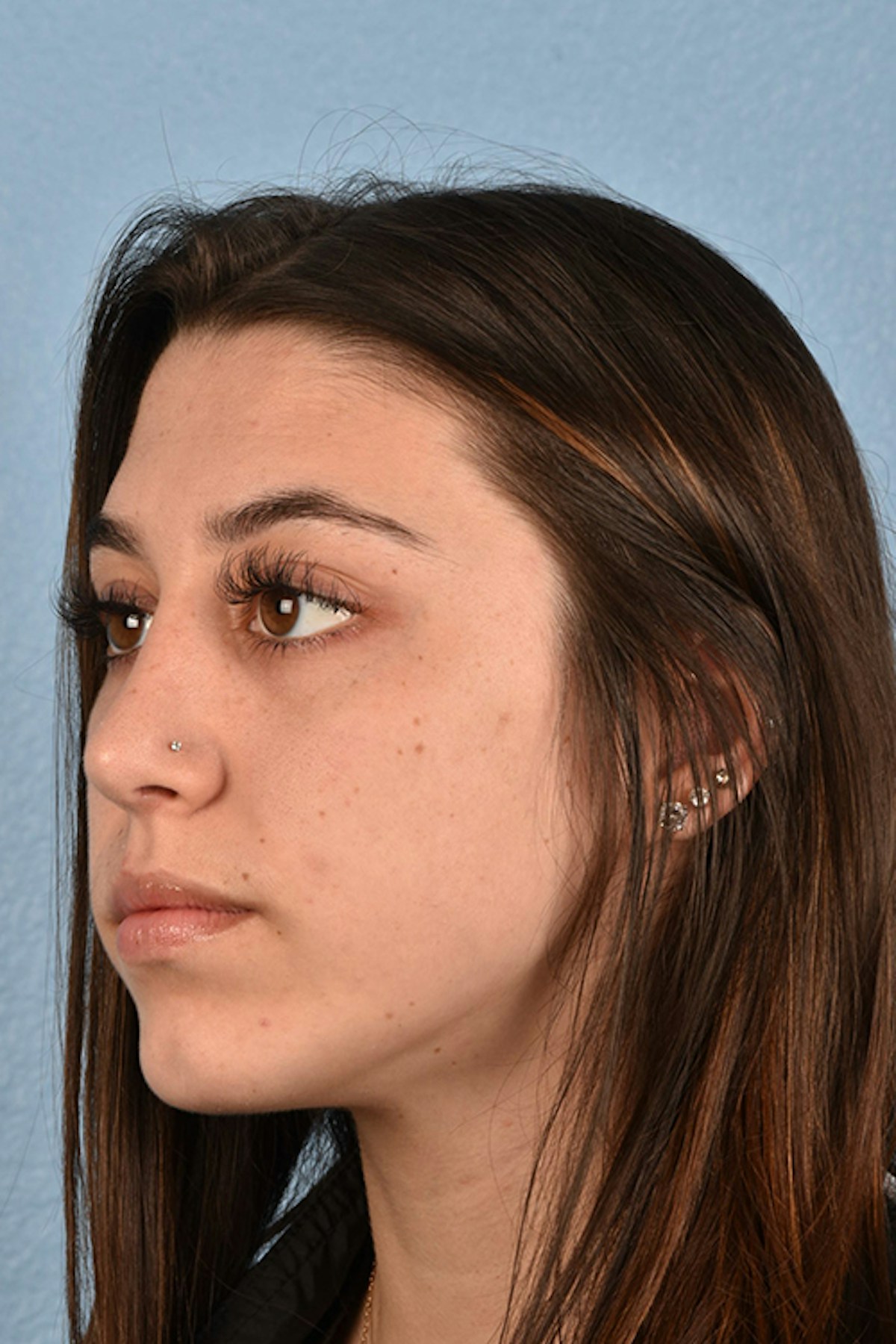 Chin Augmentation Before & After Gallery - Patient 290451 - Image 4