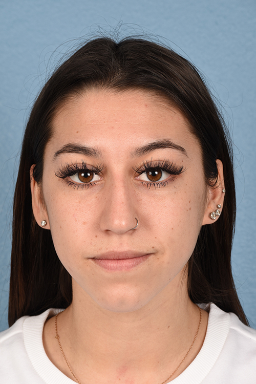 Rhinoplasty Before & After Gallery - Patient 304396 - Image 5