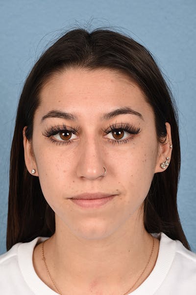 Chin Augmentation Before & After Gallery - Patient 290451 - Image 1