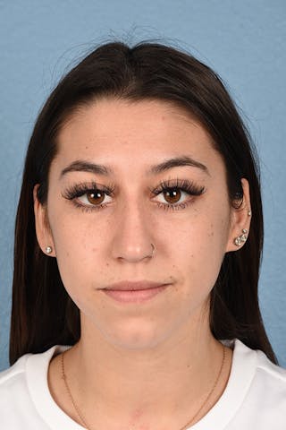 Hidden Patients Before & After Gallery - Patient 195527 - Image 1