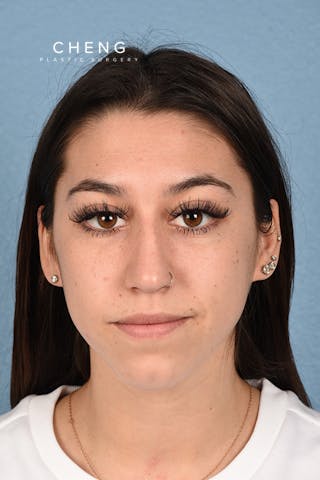 Hidden Patients Before & After Gallery - Patient 195527 - Image 1