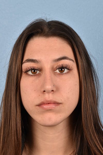 Chin Augmentation Before & After Gallery - Patient 290451 - Image 2