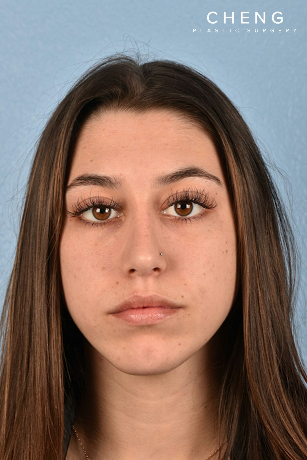 Hidden Patients Before & After Gallery - Patient 195527 - Image 2