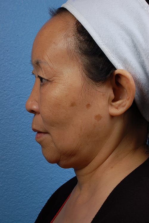 Rhinoplasty Before & After Gallery - Patient 115275 - Image 1