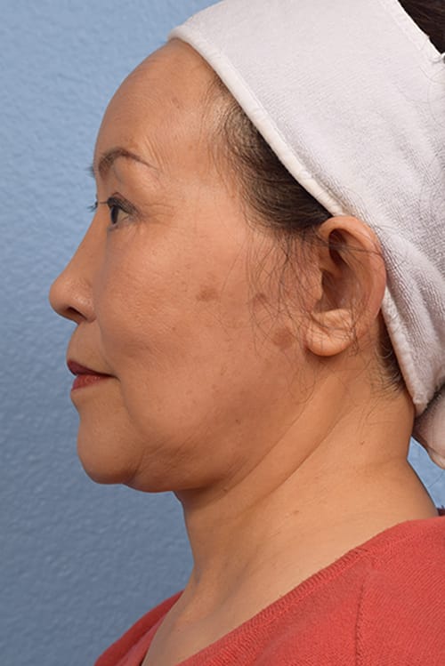 Rhinoplasty Before & After Gallery - Patient 115275 - Image 2