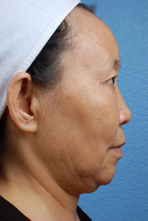 Rhinoplasty Before & After Gallery - Patient 115275 - Image 3