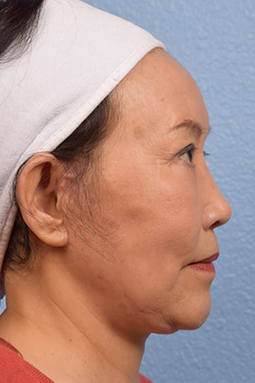 Rhinoplasty Before & After Gallery - Patient 115275 - Image 4