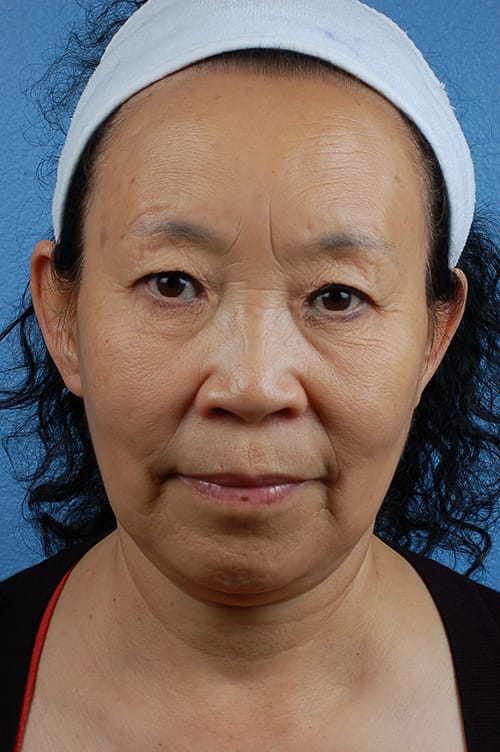 Brow Lift Before & After Gallery - Patient 375961 - Image 1