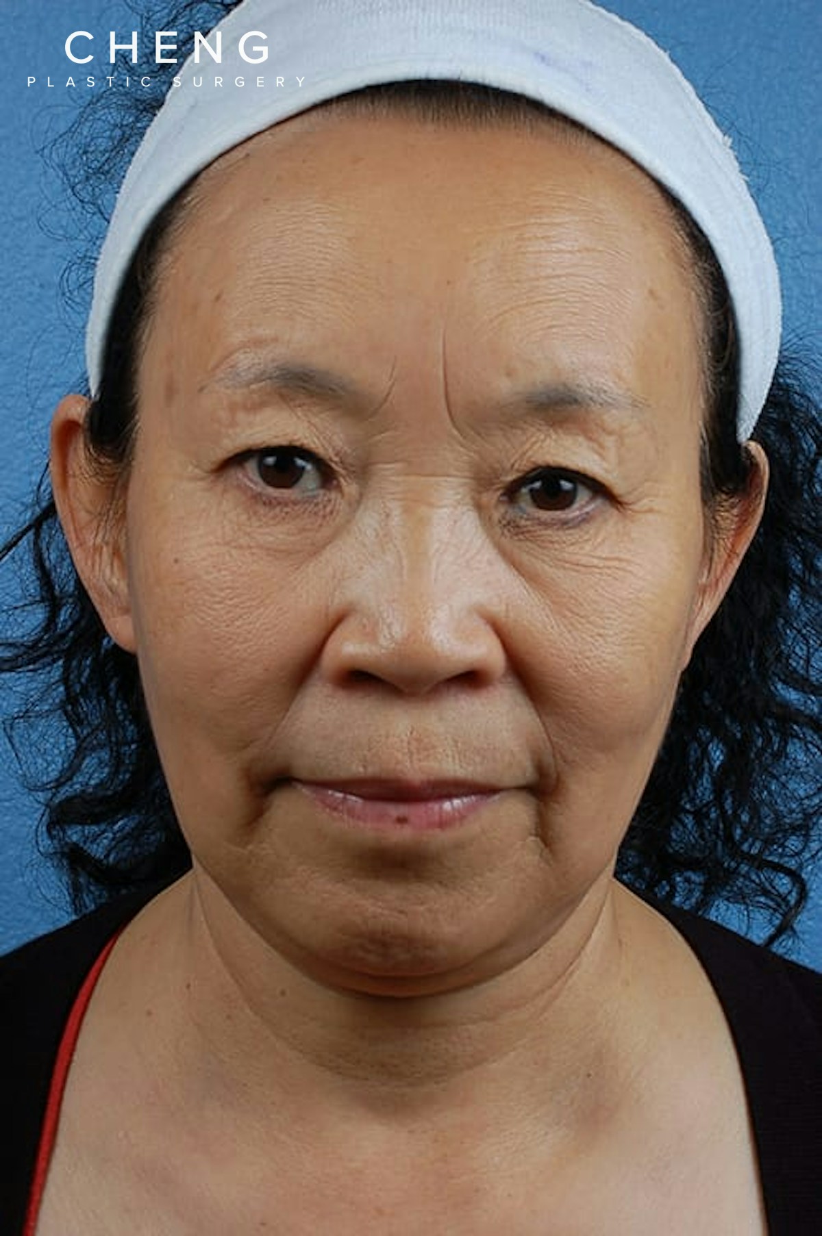 Hidden Patients Before & After Gallery - Patient 344483 - Image 1