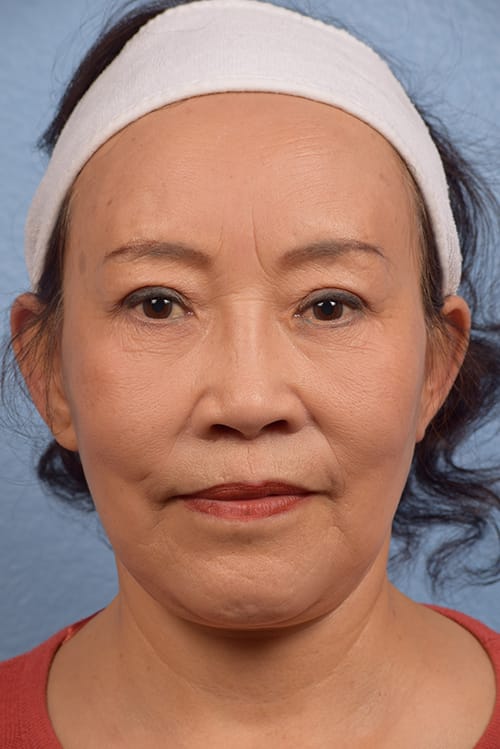 Brow Lift Before & After Gallery - Patient 375961 - Image 2