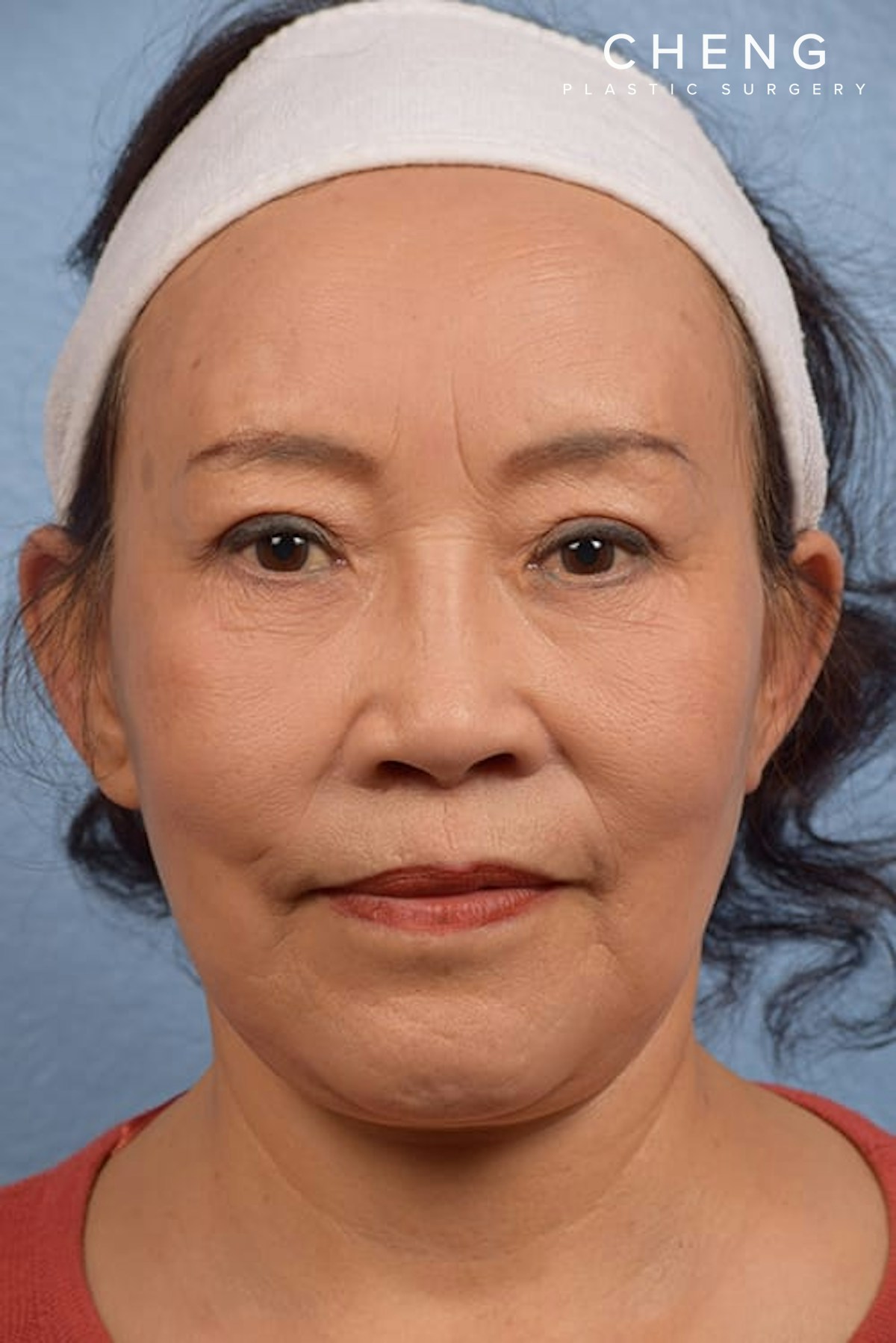 Hidden Patients Before & After Gallery - Patient 344483 - Image 2