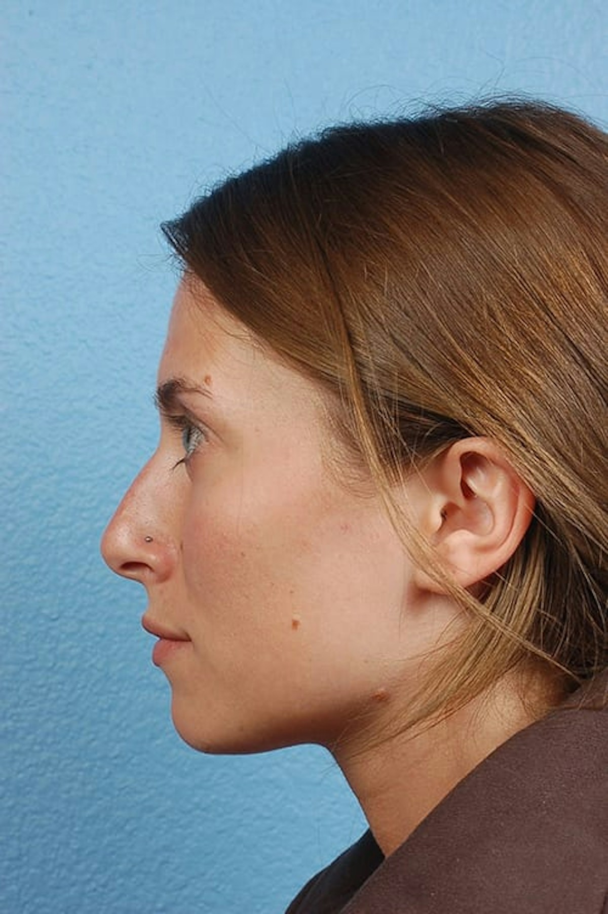 Rhinoplasty Before & After Gallery - Patient 188864 - Image 1