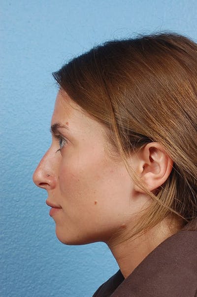 Rhinoplasty Before & After Gallery - Patient 188864 - Image 1