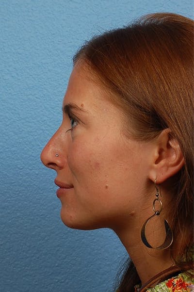 Rhinoplasty Before & After Gallery - Patient 188864 - Image 2