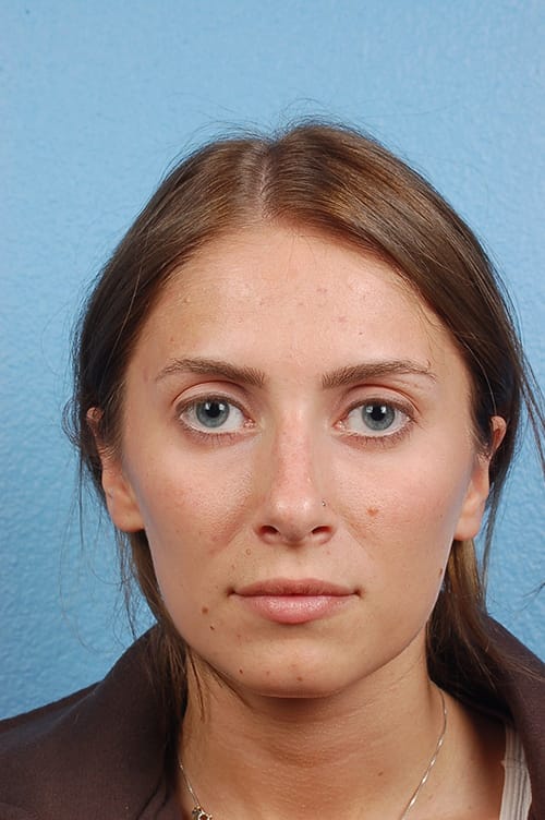 Hidden Patients Before & After Gallery - Patient 130468 - Image 3