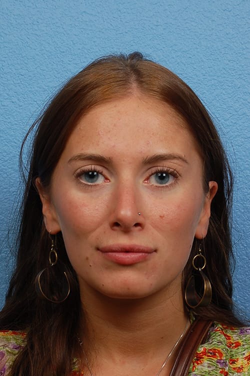 Hidden Patients Before & After Gallery - Patient 130468 - Image 4