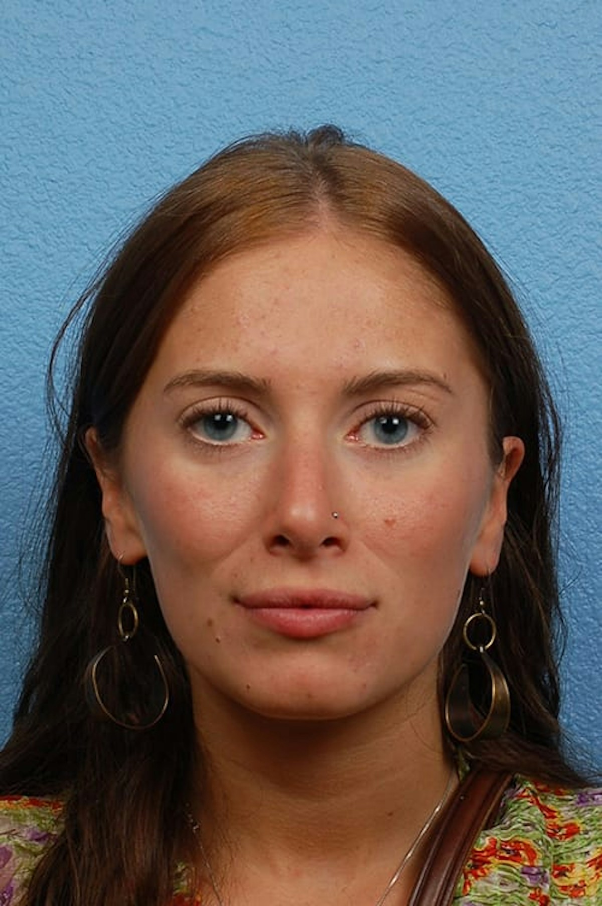 Rhinoplasty Before & After Gallery - Patient 188864 - Image 4