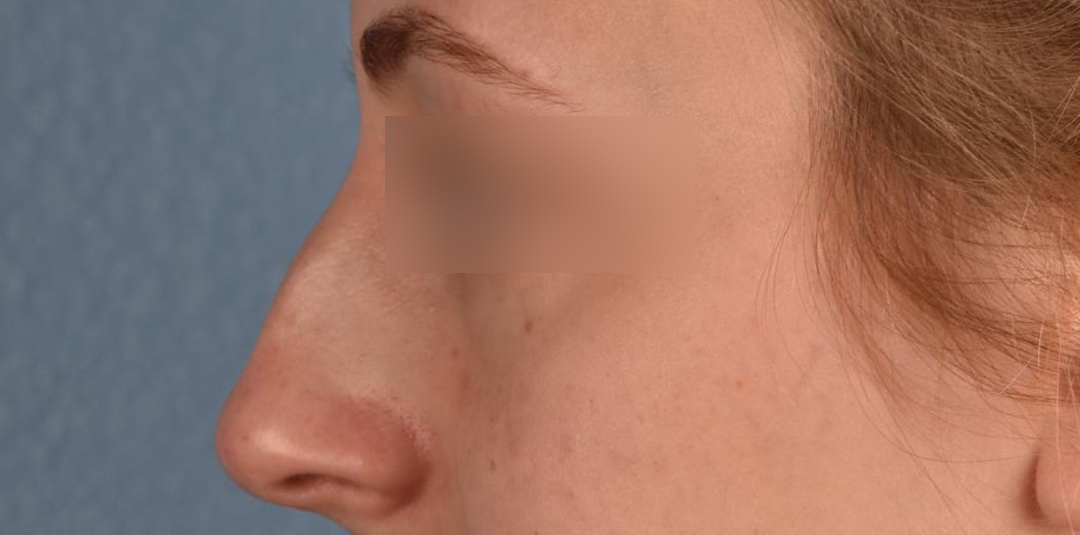 Rhinoplasty Before & After Gallery - Patient 265382 - Image 1