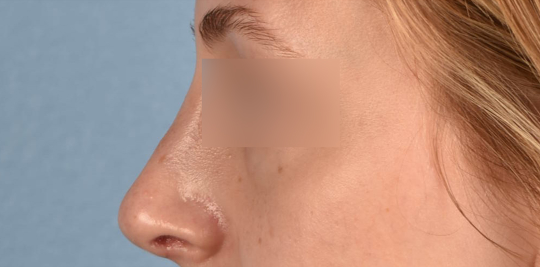 Rhinoplasty Before & After Gallery - Patient 265382 - Image 2