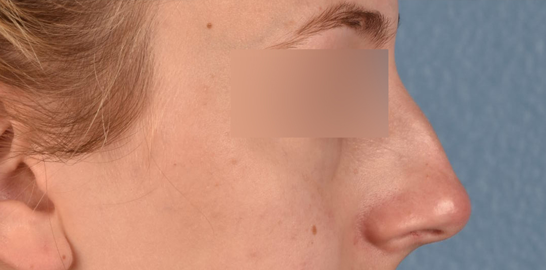 Rhinoplasty Before & After Gallery - Patient 265382 - Image 3