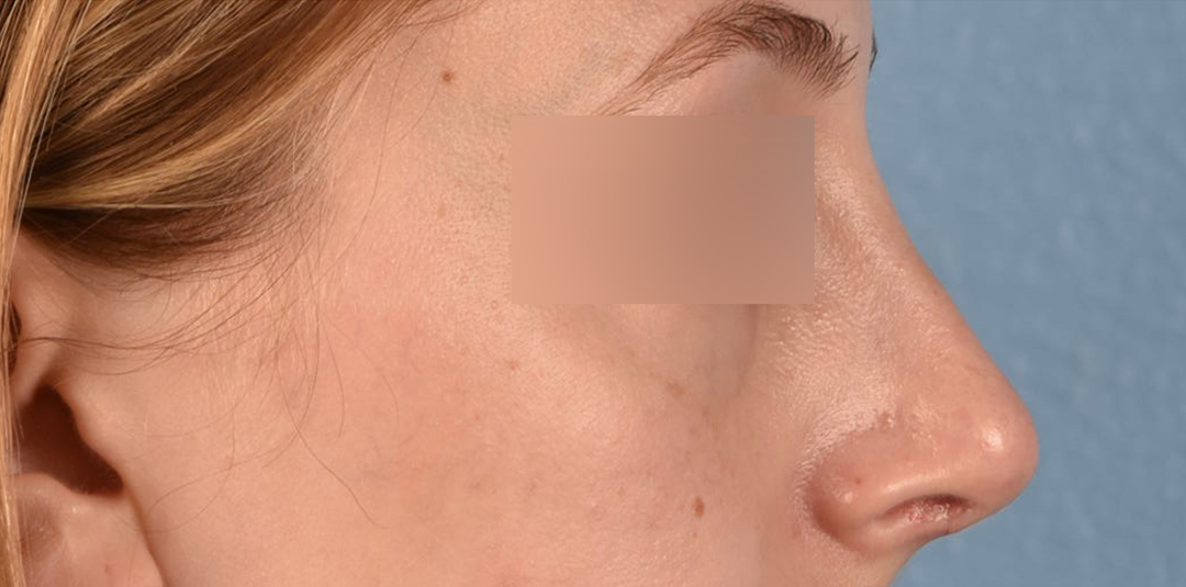 Rhinoplasty Before & After Gallery - Patient 265382 - Image 4
