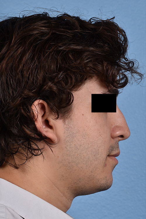 Rhinoplasty Before & After Gallery - Patient 323731 - Image 1