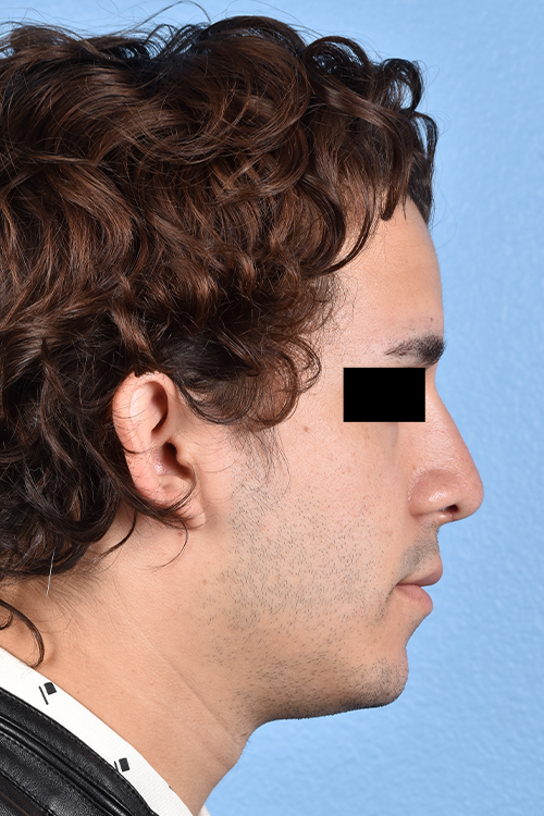 Rhinoplasty Before & After Gallery - Patient 323731 - Image 2