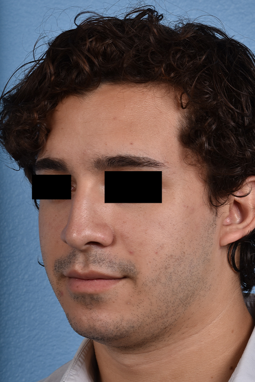 Rhinoplasty Before & After Gallery - Patient 323731 - Image 3