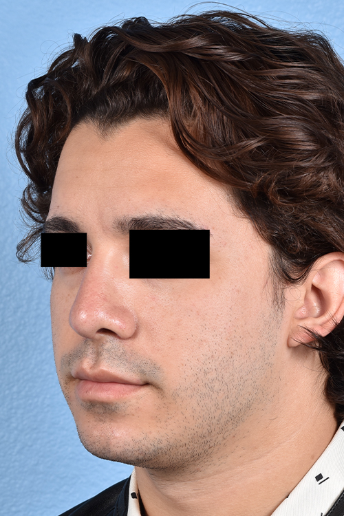 Rhinoplasty Before & After Gallery - Patient 323731 - Image 4