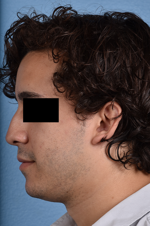 Rhinoplasty Before & After Gallery - Patient 323731 - Image 5