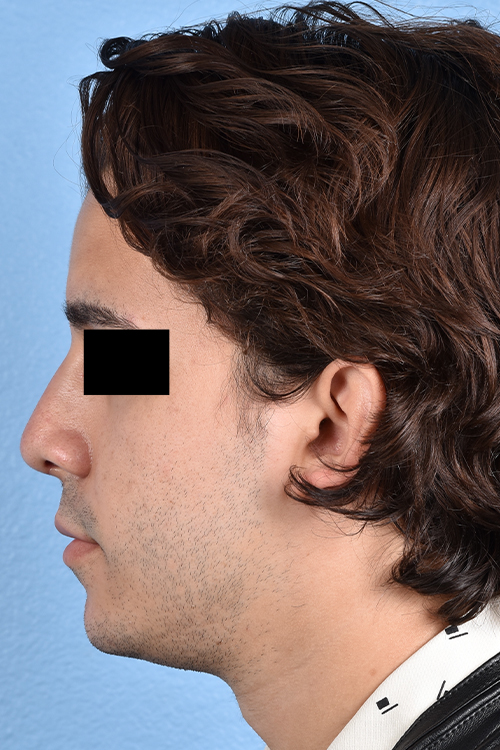 Rhinoplasty Before & After Gallery - Patient 323731 - Image 6