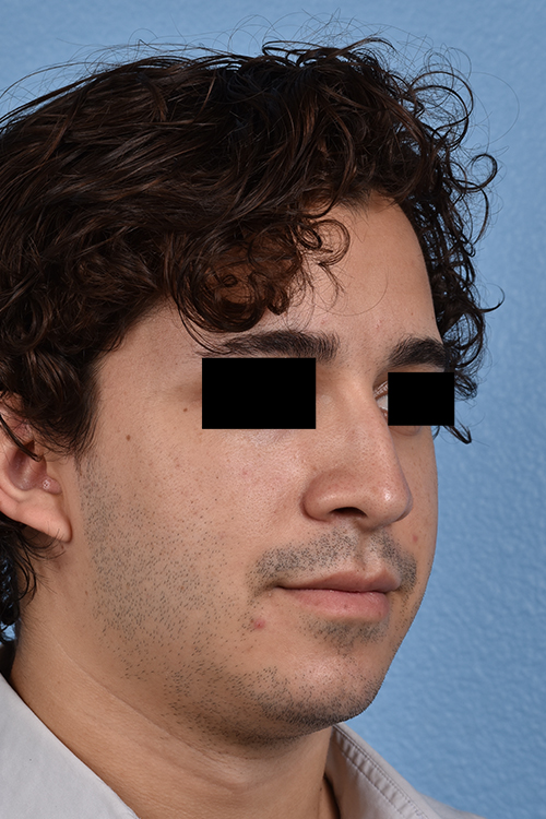 Rhinoplasty Before & After Gallery - Patient 323731 - Image 7