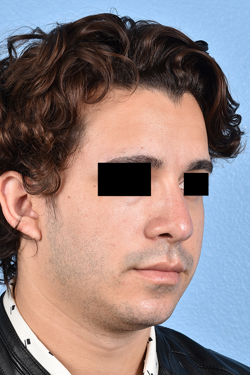 Rhinoplasty Before & After Gallery - Patient 323731 - Image 8