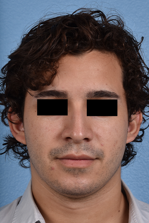 Rhinoplasty Before & After Gallery - Patient 323731 - Image 9