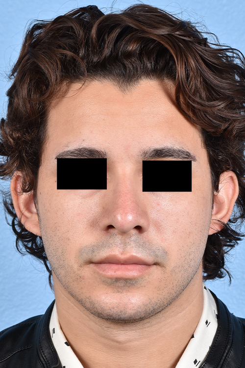 Rhinoplasty Before & After Gallery - Patient 323731 - Image 10